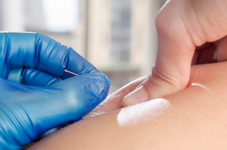 Why is the process of dry needle treatment done?